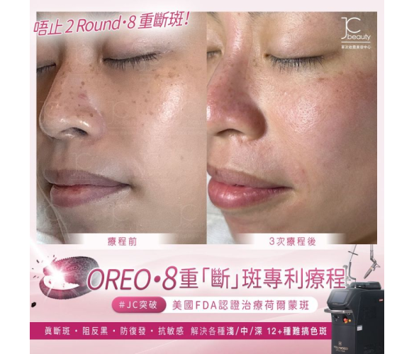 JC Beauty OREO 8重療程