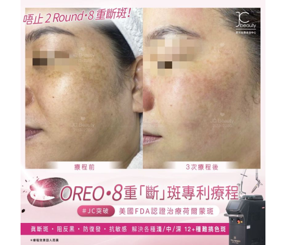 JC Beauty OREO 8重療程