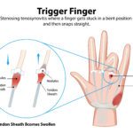 彈弓指 Trigger finger