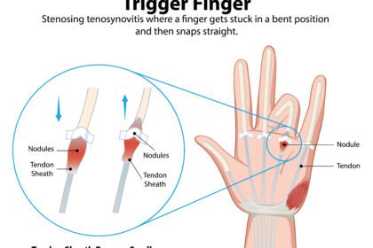 彈弓指 Trigger finger