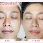 Oreo•8 重「斷」斑專利療程