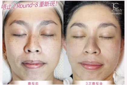 Oreo•8 重「斷」斑專利療程