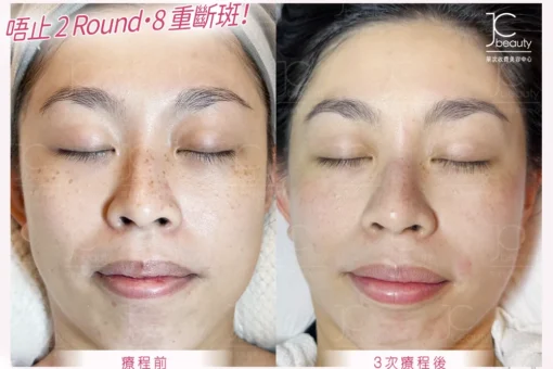 Oreo•8 重「斷」斑專利療程
