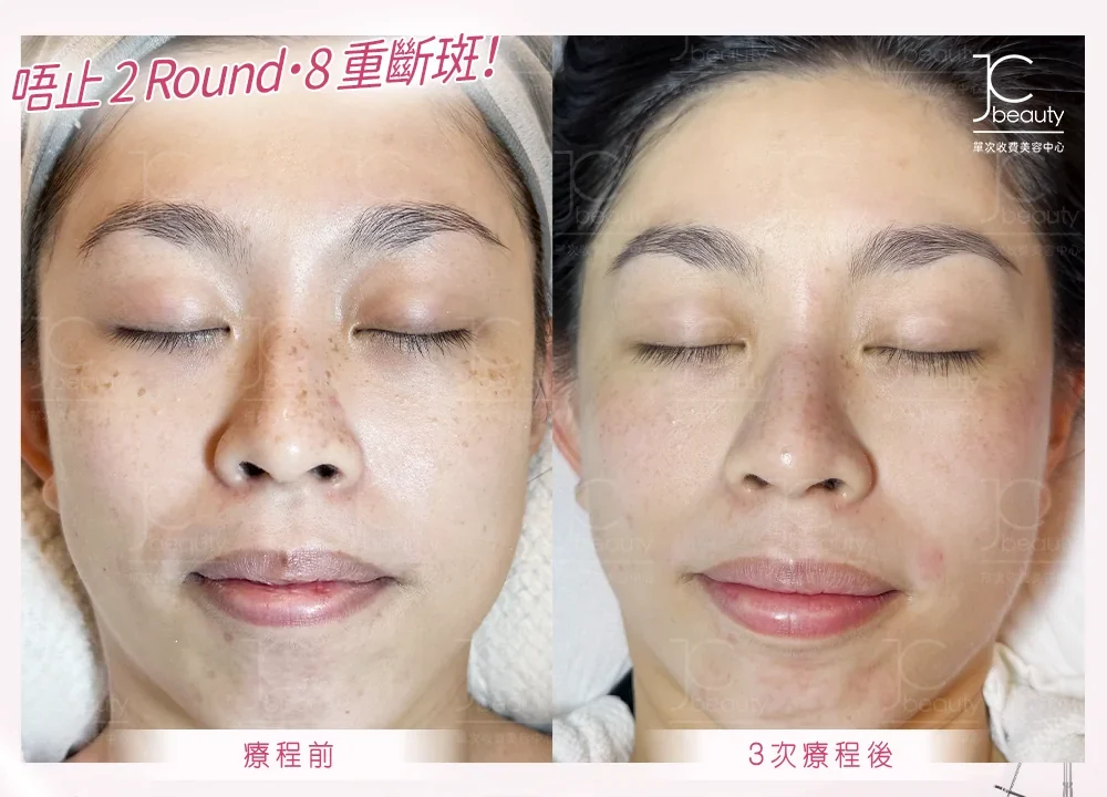 Oreo•8 重「斷」斑專利療程
