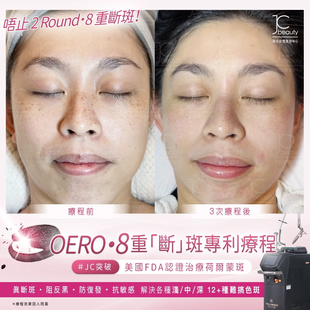 Oreo•8 重「斷」斑專利療程