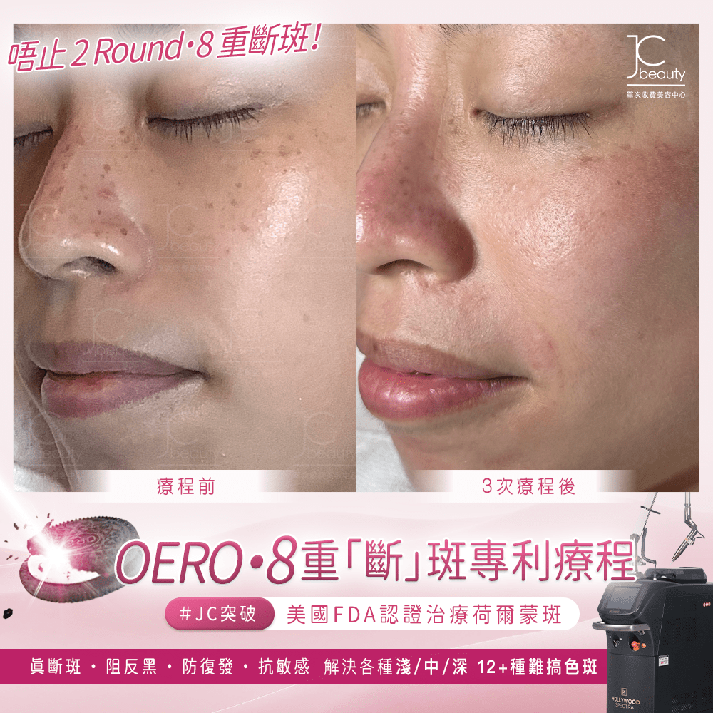 Oreo•8 重「斷」斑專利療程