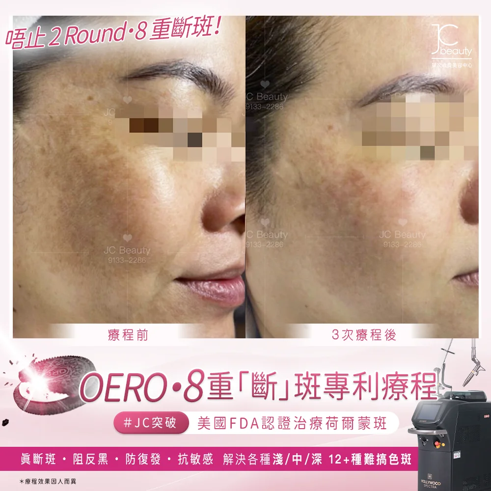 Oreo•8 重「斷」斑專利療程