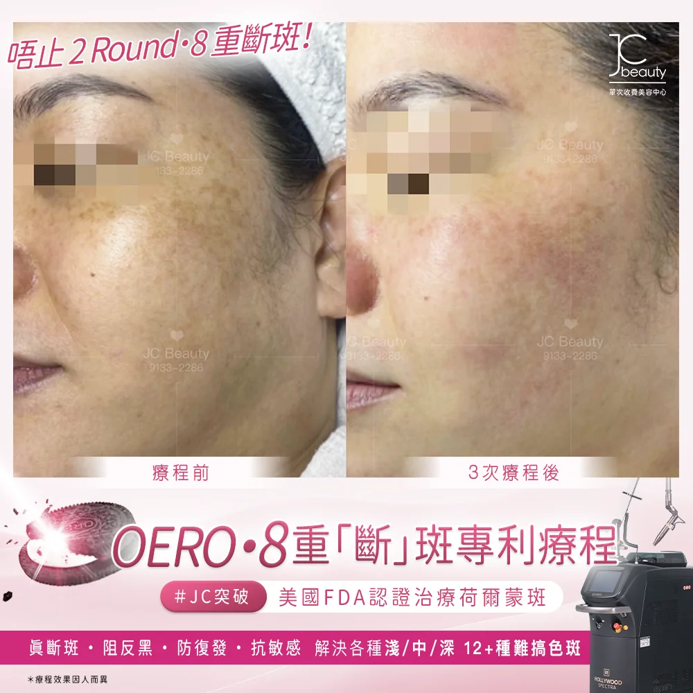 Oreo•8 重「斷」斑專利療程