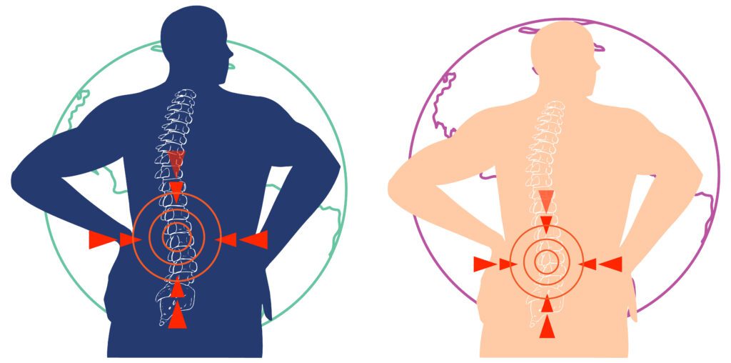 椎間盤突出，為何總與脊椎側彎共生？