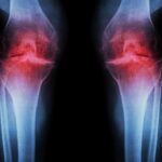 抗衰老注射劑重生膝蓋軟骨