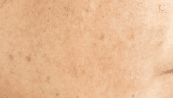 深入剖析：什麼是荷爾蒙斑？