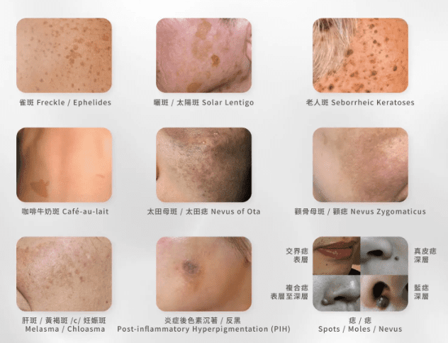 激光去斑技術的演進：從傳統激光到 Hollywood Spectra Laser