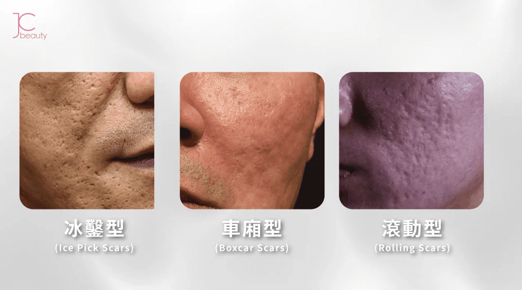 凹凸洞形成的根源：從痘痘到永久疤痕