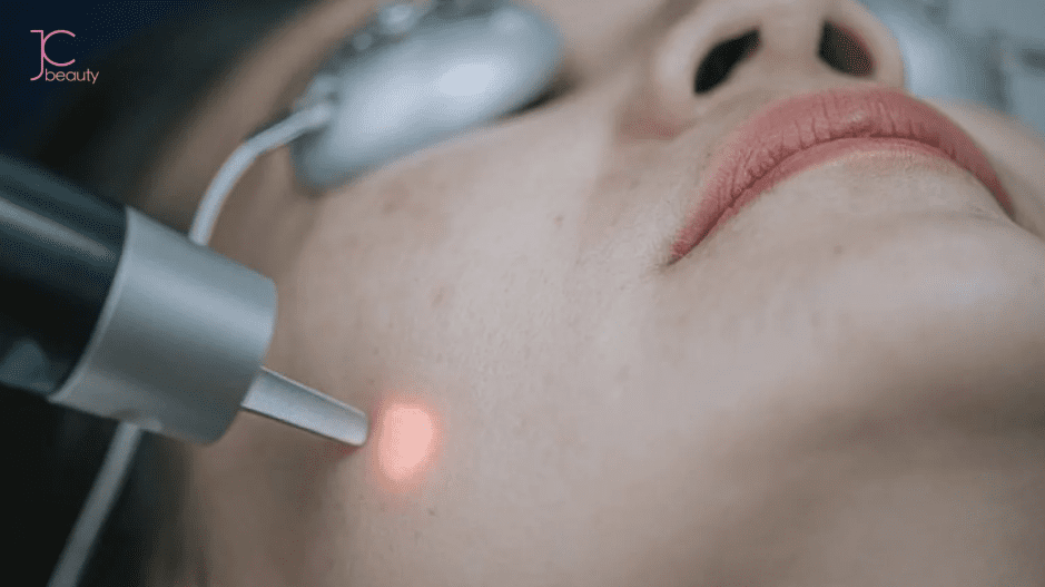 主流去斑方法大比拼：從傳統到最新科技