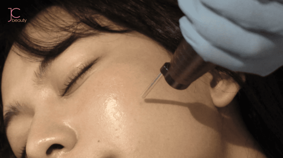 錯誤診斷：未分清色斑類型