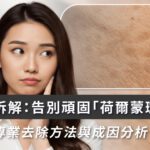 女生必看：荷爾蒙斑成因＋最新去斑方案