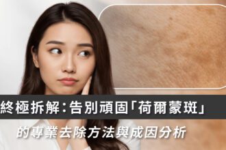 女生必看：荷爾蒙斑成因＋最新去斑方案