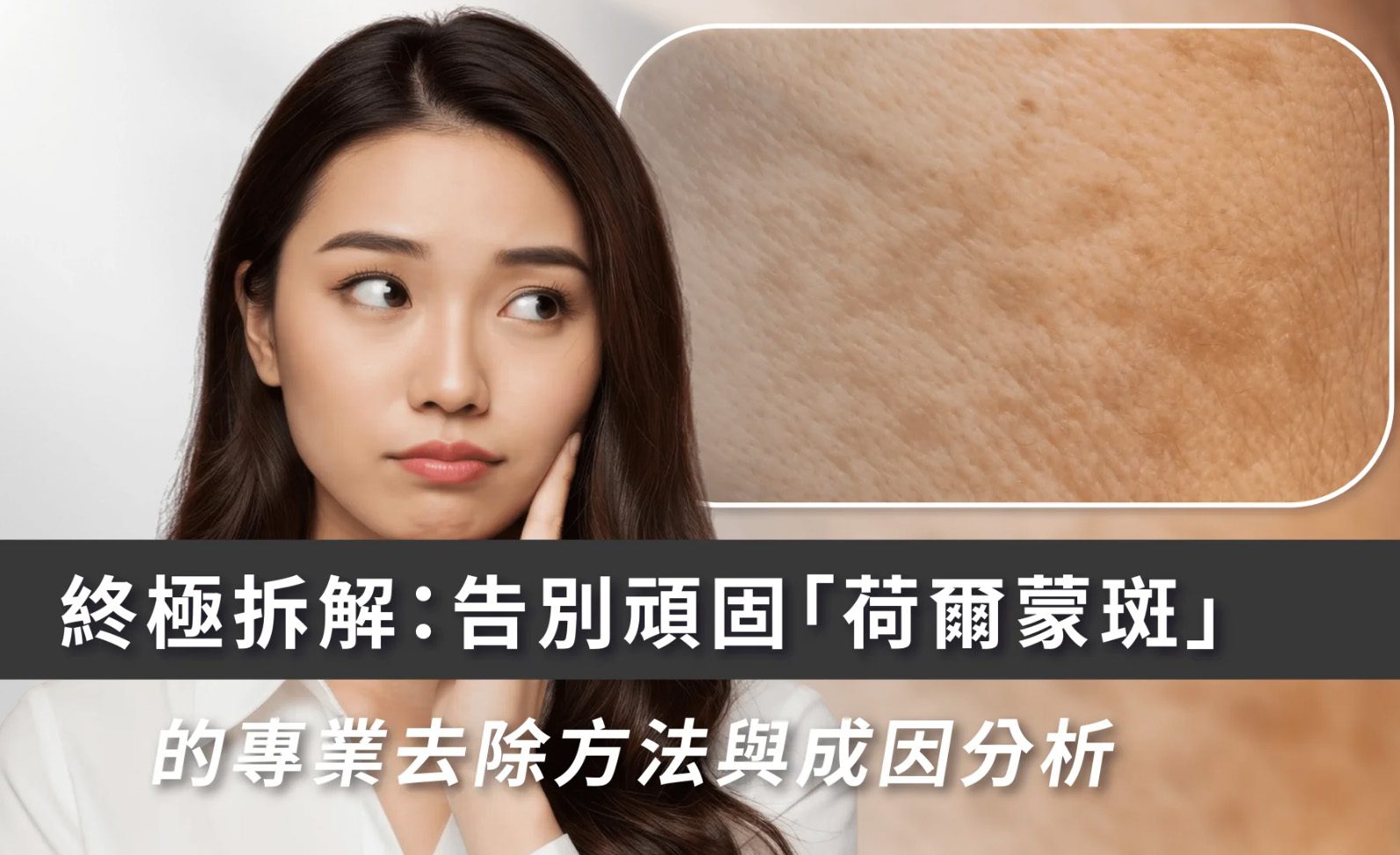 女生必看：荷爾蒙斑成因＋最新去斑方案