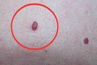 身上的「紅點」